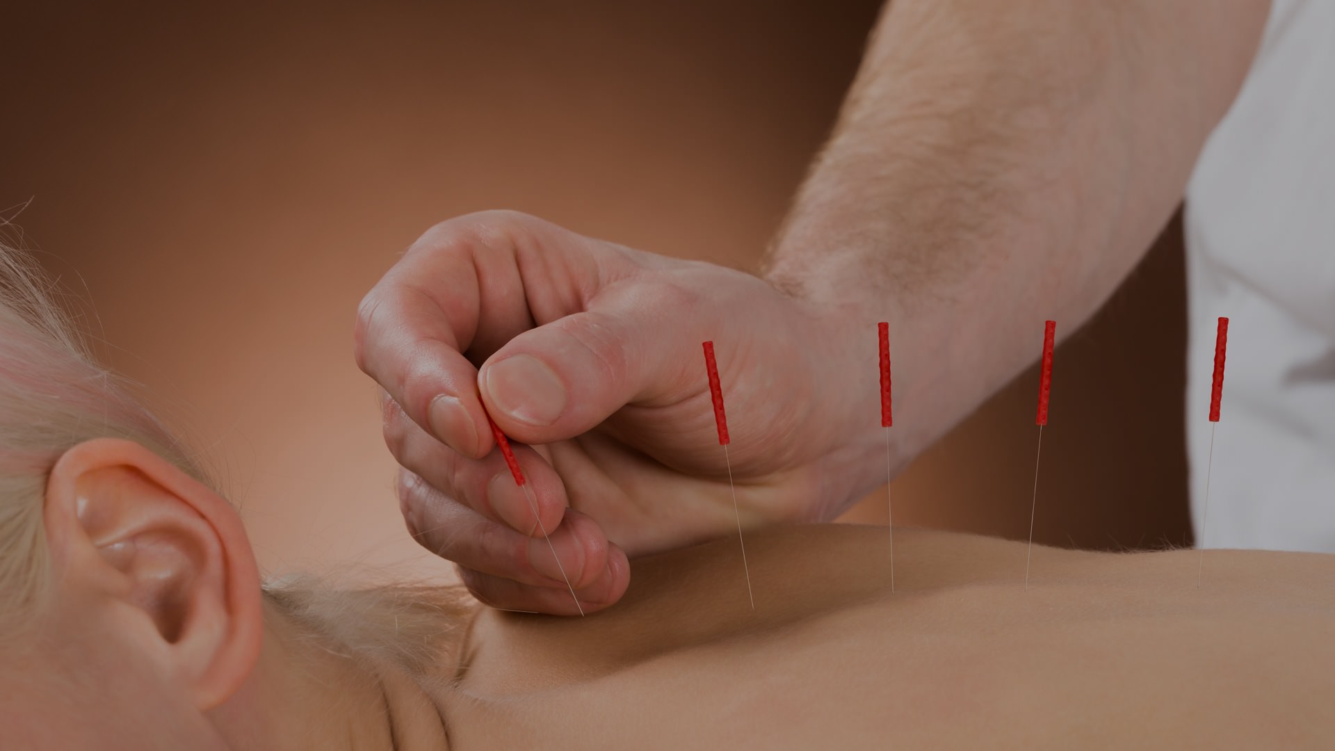 Man Getting Acupuncture